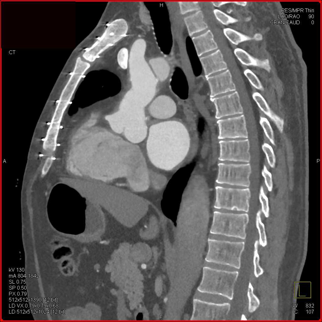 Type B Aortic Dissection - CTisus CT Scan