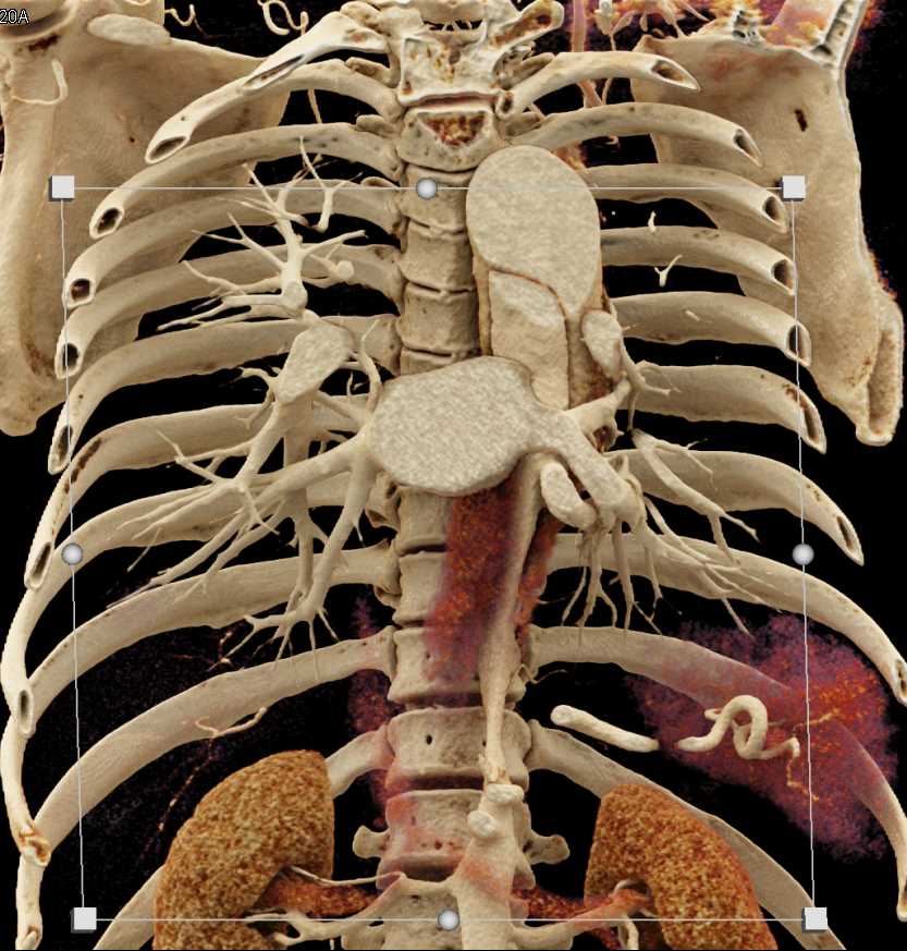 Type B Aortic Dissection - CTisus CT Scan