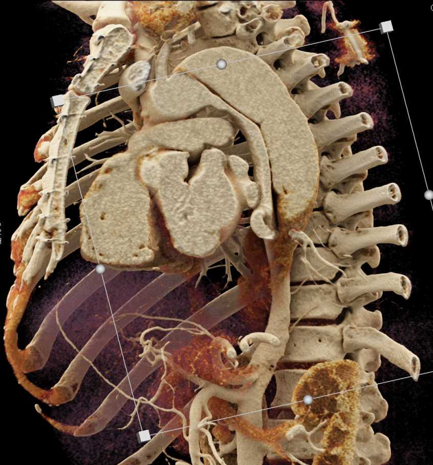 Type A Dissection with Cinematic Rendering - CTisus CT Scan