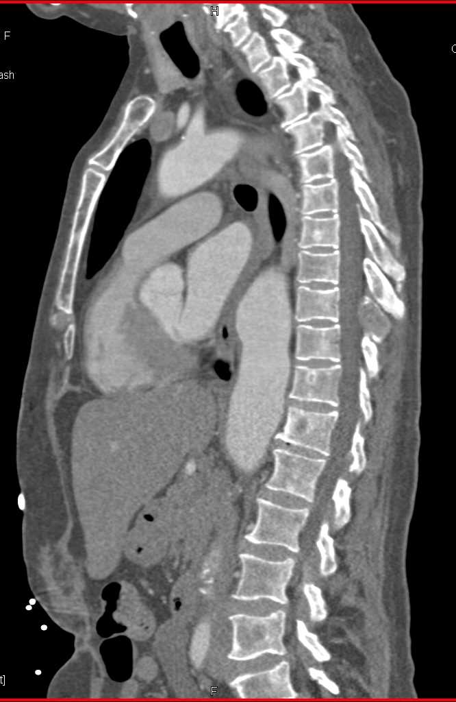 Dissection Descending Thoracic Aorta - CTisus CT Scan