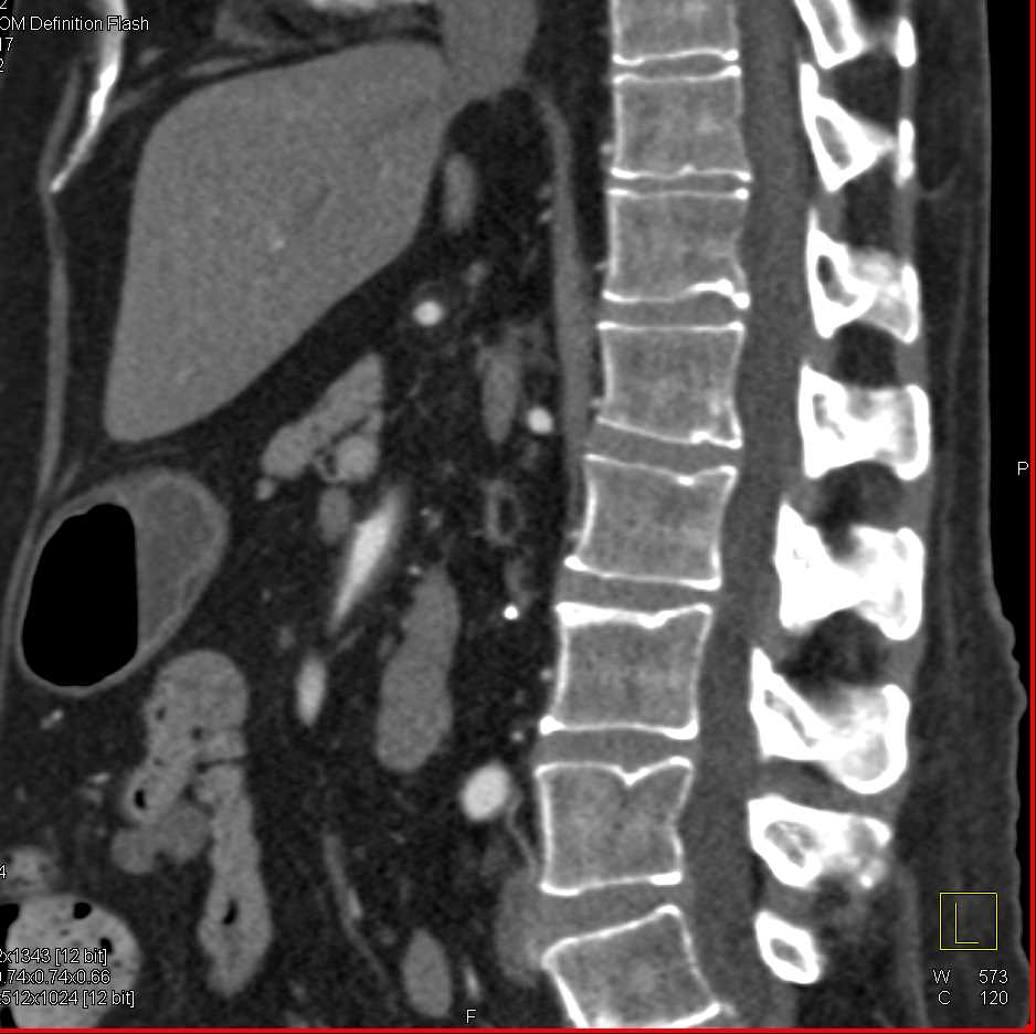 Vasculitis Involves the Superior Mesenteric Artery (SMA) - CTisus CT Scan