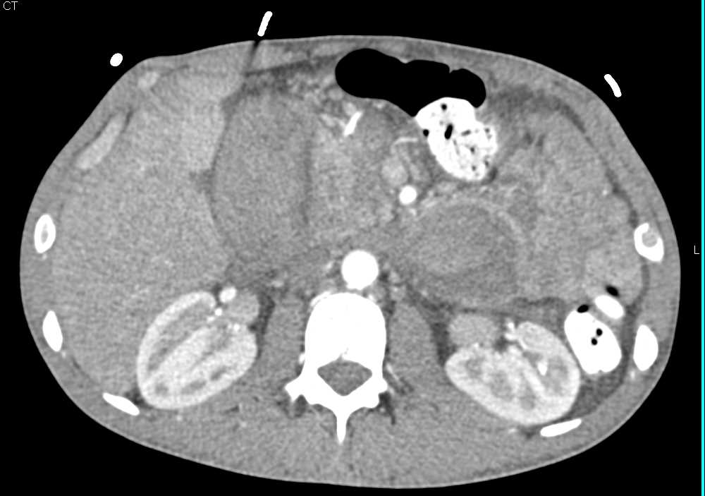 Vasculitis with Multiple Small Aneurysms in Renal and Mesenteric Arteries - CTisus CT Scan