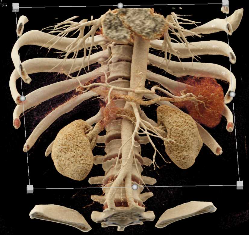 Mesenteric Arcade - CTisus CT Scan