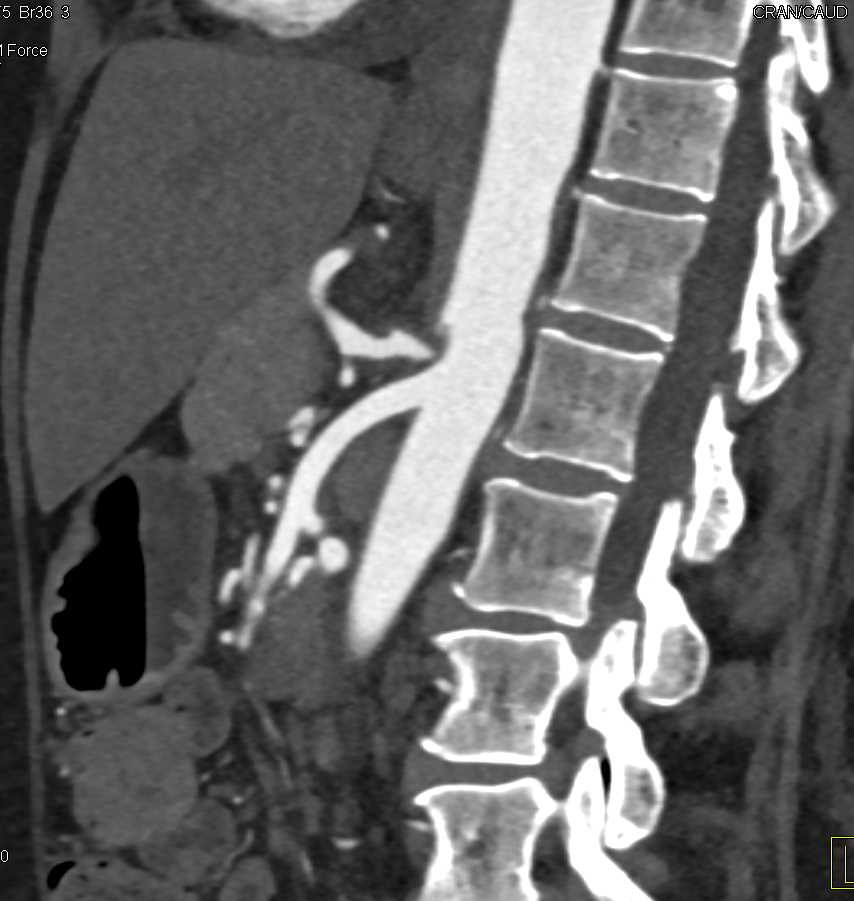 Celiac Stenosis due to Median Arcuate Ligament Compression - CTisus CT Scan