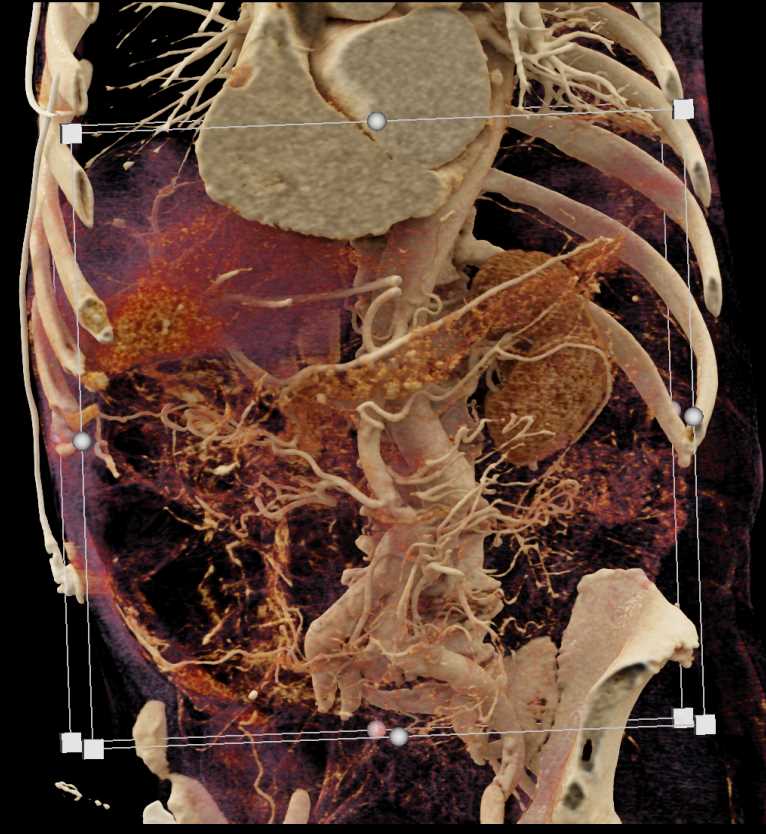 Vasculitis Involves Small Bowel - CTisus CT Scan