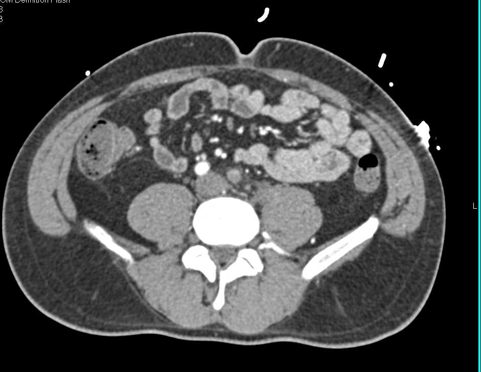Occlusion Left Common Iliac Artery - CTisus CT Scan
