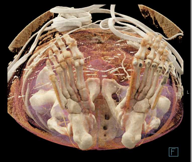 Occlusion Left Common Iliac Artery - CTisus CT Scan