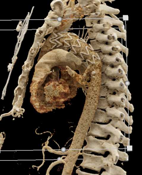 Aortic Ulcer with Intramural Hematoma - CTisus CT Scan