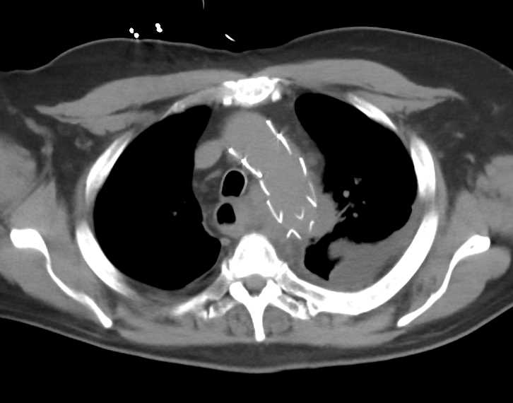 Aortic Ulcer with Intramural Hematoma - CTisus CT Scan
