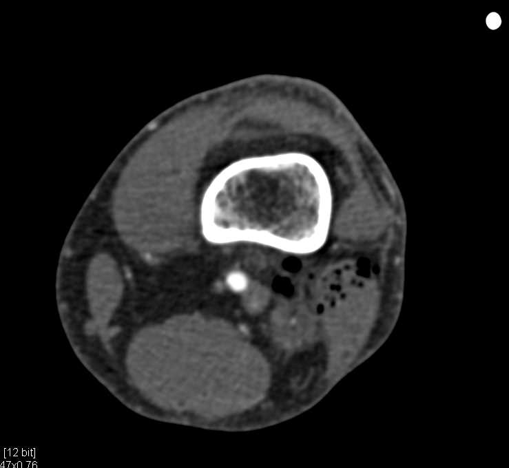 Gunshot Wound (GSW) Without Vascular Injury - CTisus CT Scan