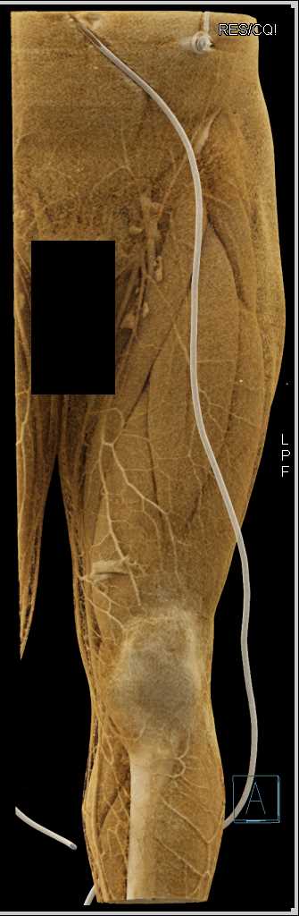 GSW Without Vascular Injury - CTisus CT Scan