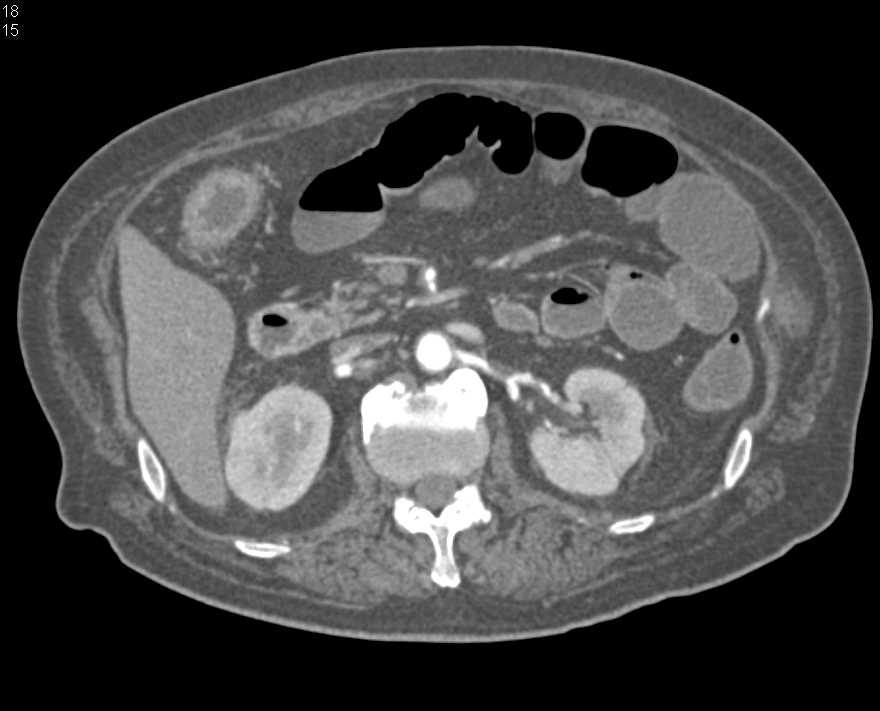 High Grade Stenosis Superior Mesenteric Artery (SMA) with Ischemic Small Bowel - CTisus CT Scan