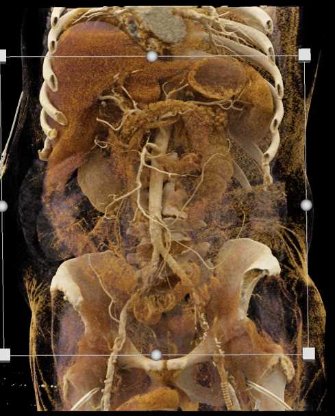 Vasculitis Involves Multiple Vessels - CTisus CT Scan