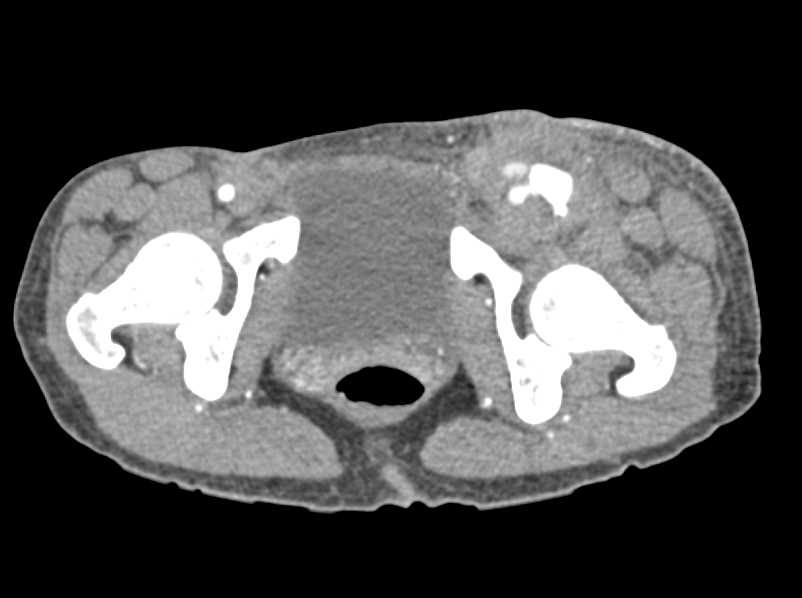 Pseudoaneurysm Left Groin - CTisus CT Scan