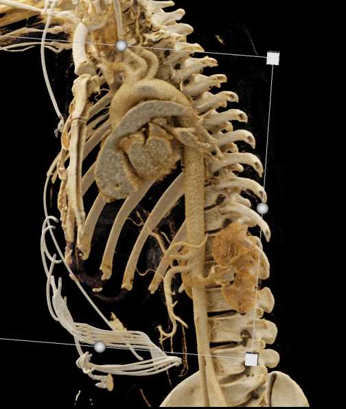 Aortic Transection - CTisus CT Scan