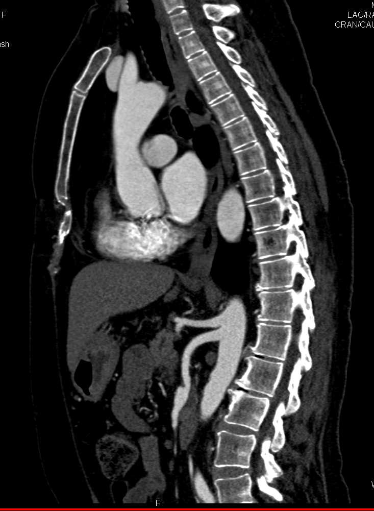 SMA Dissection - CTisus CT Scan