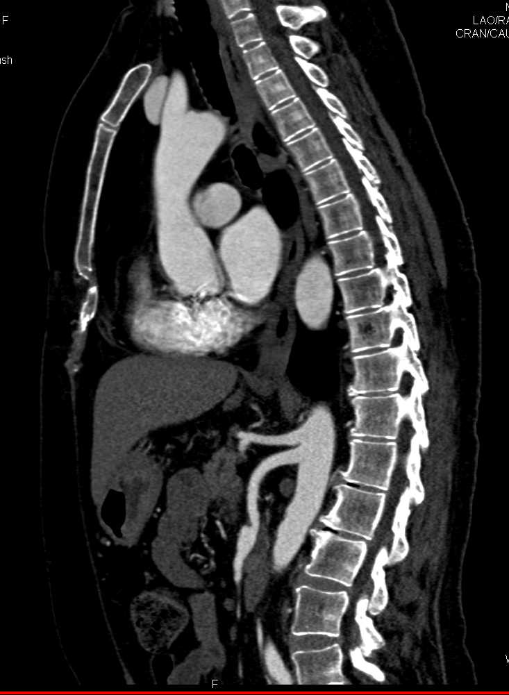 Superior Mesenteric Artery (SMA) Dissection - CTisus CT Scan