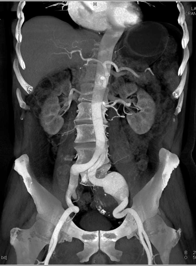 Left Common Iliac Artery Aneurysm - CTisus CT Scan