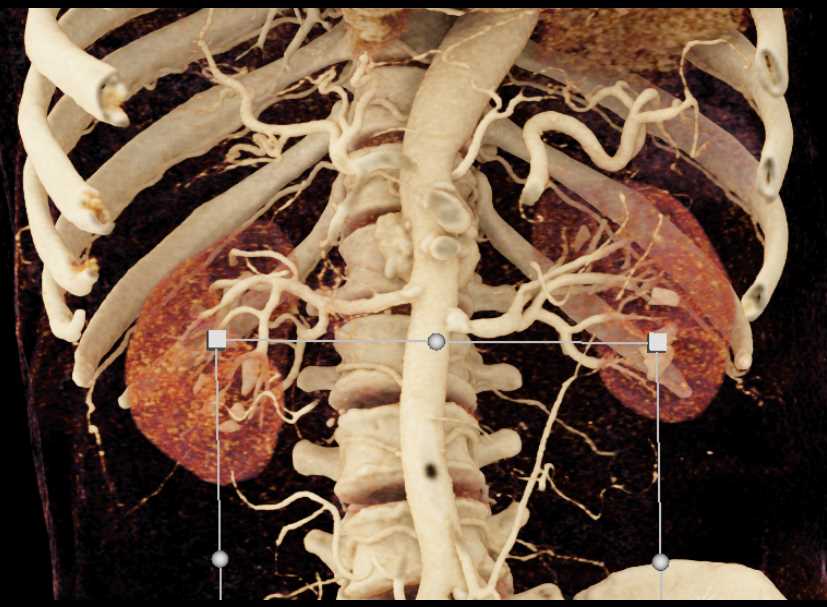 High Grade Celiac and Superior Mesenteric Artery (SMA) Stenosis with Vascular Bypass Grafts with Cinematic Rendering - CTisus CT Scan