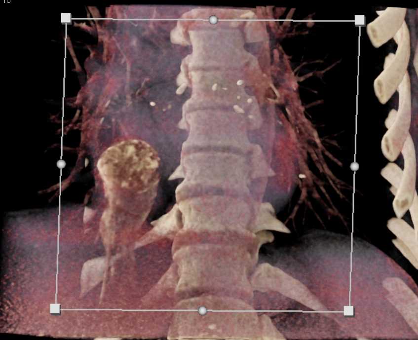 Tumor Extends into Heart from Inferior Vena Cava (IVC) - CTisus CT Scan