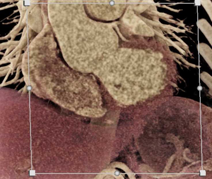 Dilated Aortic Root with Cinematic Rendering (CR) - CTisus CT Scan