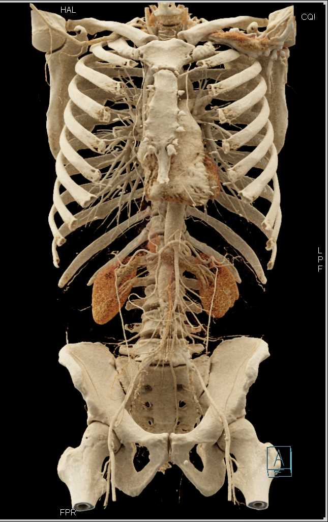 Mesenteric Arcade - CTisus CT Scan