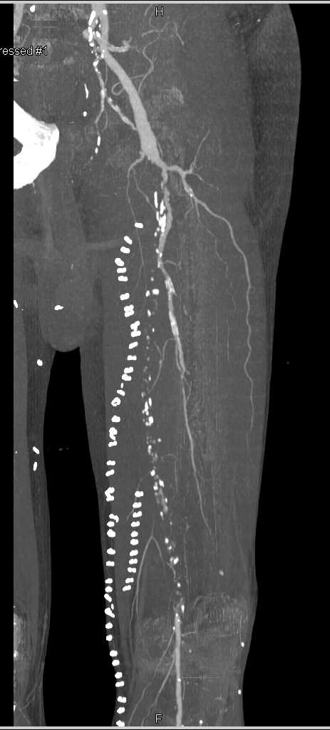 Superficial Femoral Artery (SFA) Occlusion with Failed Grafts - CTisus CT Scan