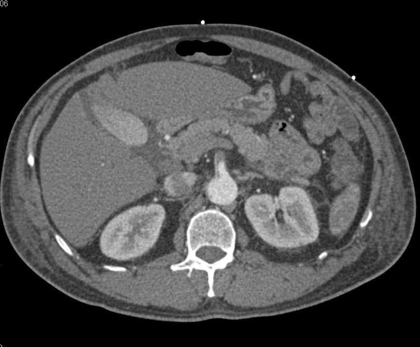 Aortic Dissection Extends into Superior Mesenteric Artery (SMA) with Occlusion - CTisus CT Scan