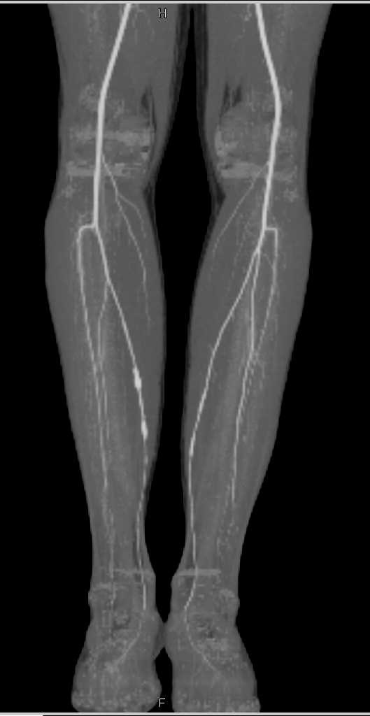 CTA Runoff with Mild Peripheral Vascular Disease (PVD) Lower Extremities - CTisus CT Scan