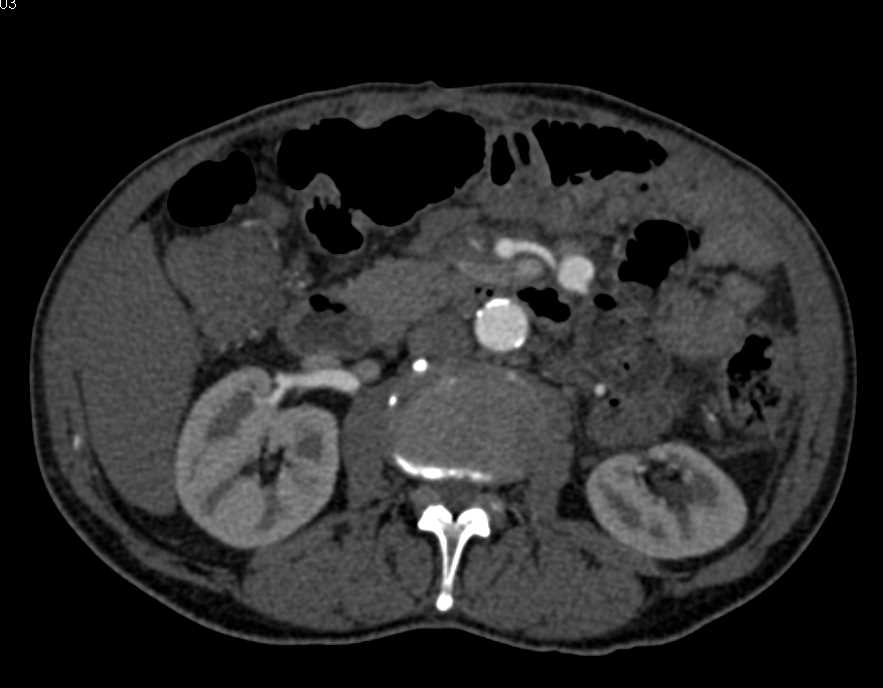 Aneurysm off the Jejunal Branch of the Superior Mesenteric Artery (SMA) - CTisus CT Scan