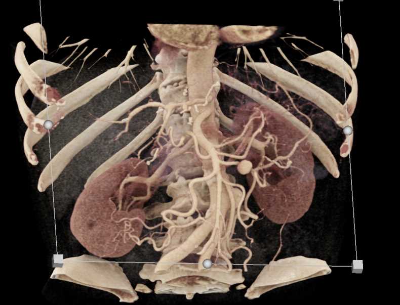 Aneurysm off the Jejunal Branch of the Superior Mesenteric Artery (SMA) - CTisus CT Scan