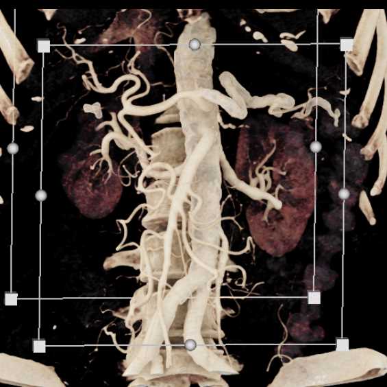Superior Mesenteric Artery (SMA) and Celiac Artery Branching - CTisus CT Scan