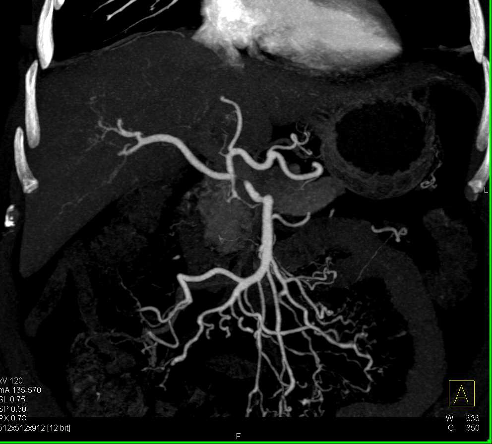 Vasculitis Involves the Superior Mesenteric Artery (SMA) - CTisus CT Scan
