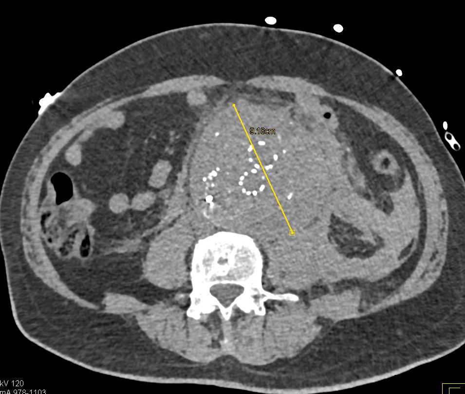 Leaking Abdominal Aortic Aneurysm with Endovascular Aneurysm Repair (EVAR) - CTisus CT Scan