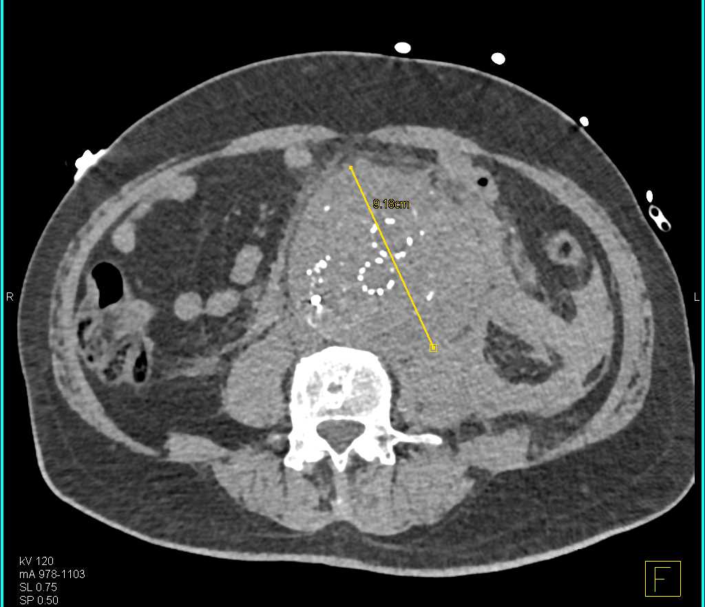 Leaking Abdominal Aortic Aneurysm with Endovascular Aneurysm Repair (EVAR) - CTisus CT Scan