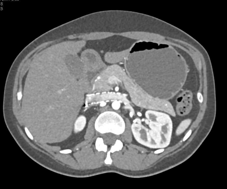 Stent in Inferior Vena Cava (IVC) and Renal Vein - CTisus CT Scan
