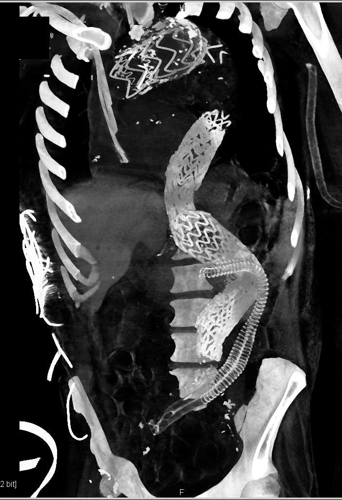 Complex Endovascular Stent Repair - CTisus CT Scan