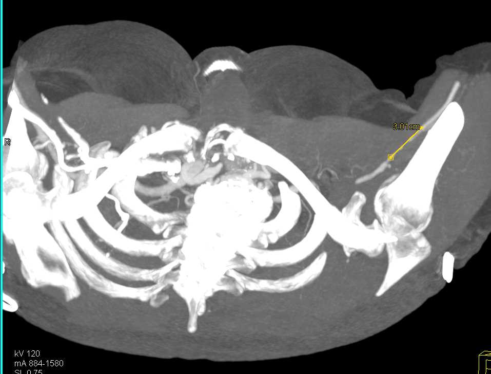 Irregularity Left Brachial Artery - CTisus CT Scan