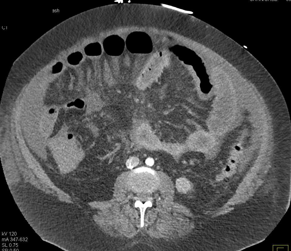 Carcinomatosis with Inferior Vena Cava (IVC) Clot - CTisus CT Scan