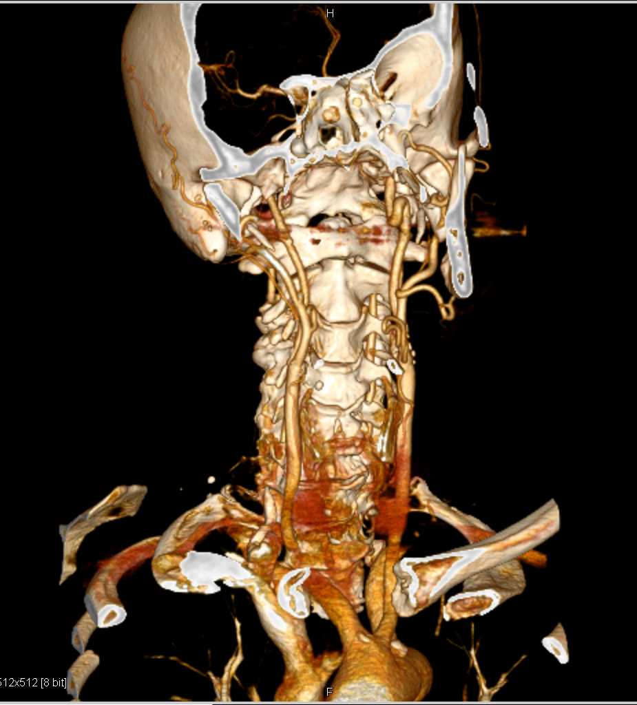 Carotid Artery Plaque - CTisus CT Scan