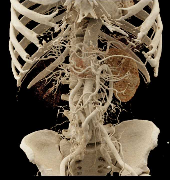 Multiple Grafts Arising from the Right Common Iliac Artery with CR - CTisus CT Scan