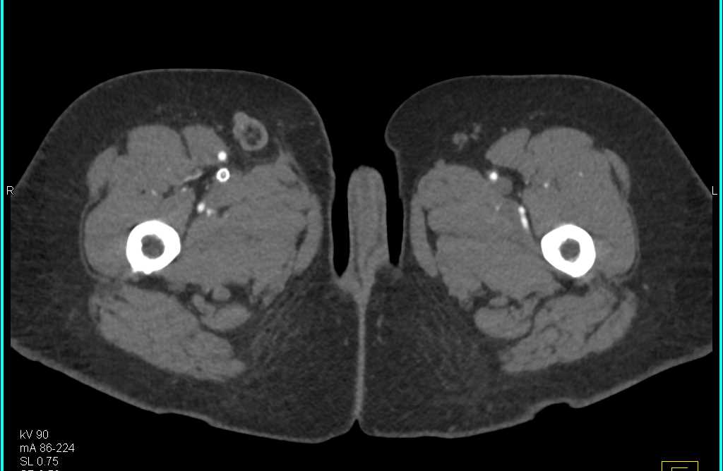 CTA Runoff with Vascular Stents - CTisus CT Scan