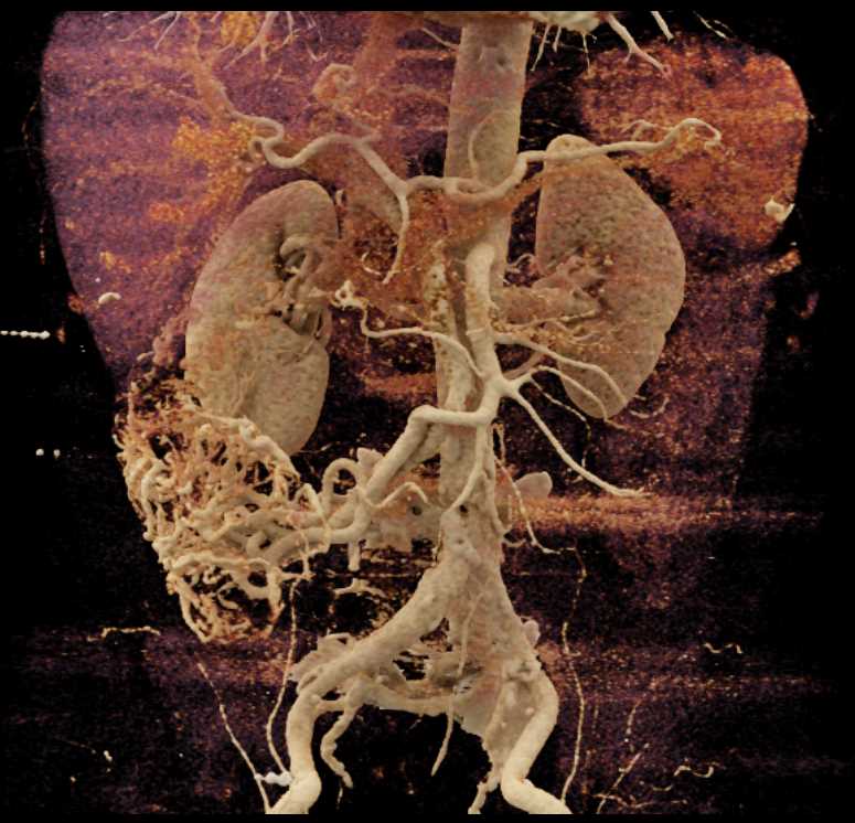 Angiodysplasia Cecum - CTisus CT Scan