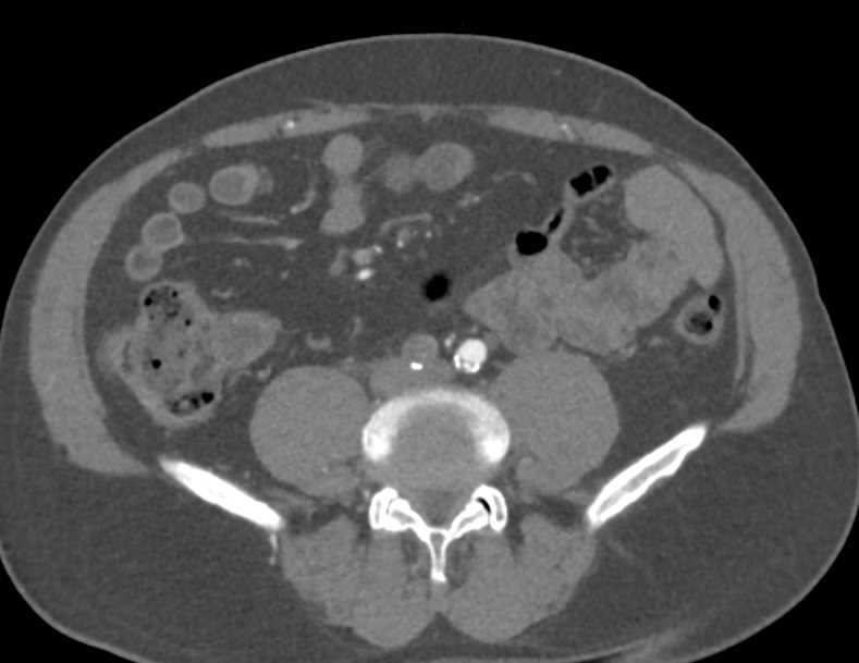 Occlusion of the Right Common Iliac Artery - CTisus CT Scan