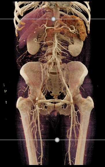Occlusion of the Right Common Iliac Artery with Fem-Fem Bypass Graft - CTisus CT Scan