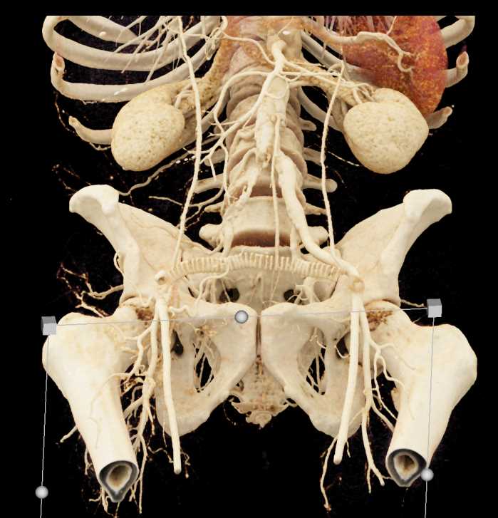 Occlusion of the Right Common Iliac Artery with Fem-Fem Bypass Graft - CTisus CT Scan