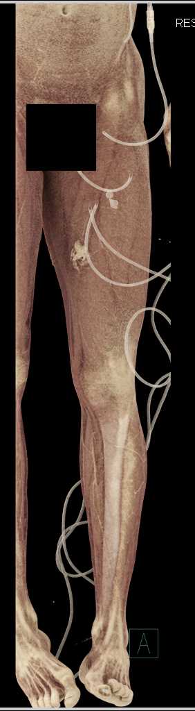SFA Occlusion - CTisus CT Scan