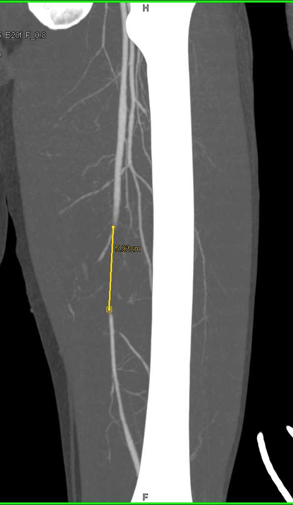 SFA Occlusion - CTisus CT Scan