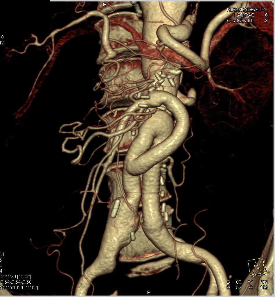 Repair of Aortic Aneurysm - CTisus CT Scan