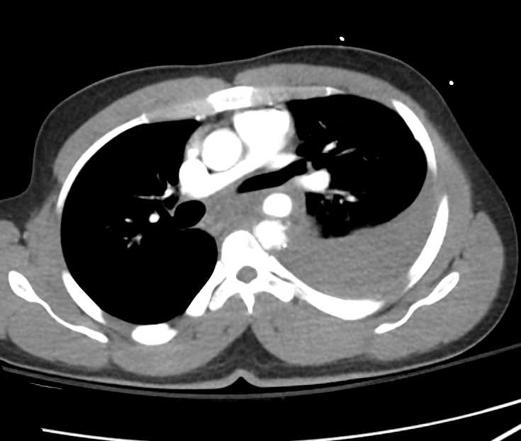 Aortic Injury Post Trauma - CTisus CT Scan